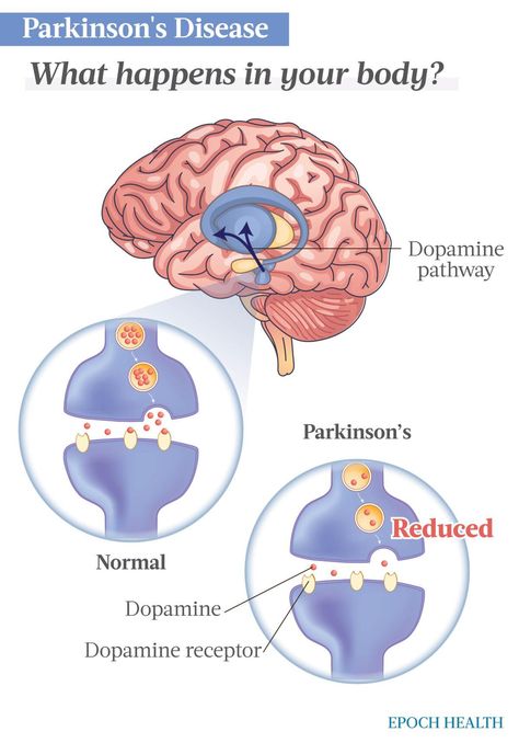 The Essential Guide to Parkinson’s Disease: Symptoms, Causes, Treatments, and Natural Remedies | The Epoch Times Parkinson Disease, Gait Training, Lewy Body, Pain Relief Remedies, Personality Psychology, Disease Symptoms, Science Notes, Joints Pain Relief, Pain Relief