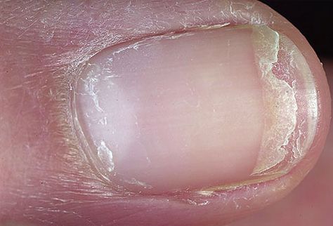 Split fingernail-Cracked or Split Nails  Dry, brittle nails that frequently crack or split have been linked to thyroid disease. Cracking or splitting combined with a yellowish hue is more likely due to a fungal infection. Nail Disorders, Nail Remedies, Do It Yourself Nails, Split Nails, Cracked Nails, Peeling Nails, Nail Infection, Weak Nails, Fungal Nail