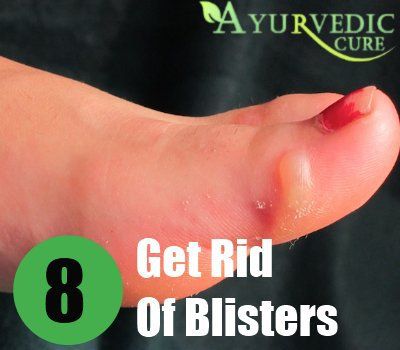 Get Rid Of Blisters Sun Blisters, How To Treat Blisters, Heal Blisters, Blister Remedies, Water Blister, How To Heal Blisters, Blister Care, Blood Blister, Skin Blisters