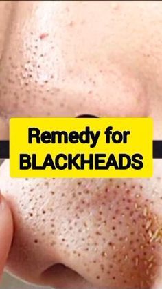 Home Remedy For Blackheads, Remedy For Blackheads, Nose Pimples, For Blackheads, Blackhead Remedies, Mekap Mata, Blackheads On Nose, Losing 40 Pounds, Natural Face Skin Care