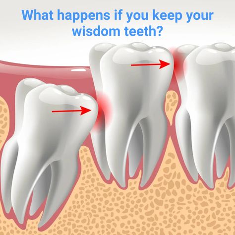 🦷😖 Don't let pesky wisdom teeth cause you pain and discomfort! We know firsthand that these teeth can be a real headache. If a tooth is positioned poorly or erupting in the wrong spot, it's clear that trouble is brewing. So, why suffer and endure more problems down the line? This article on @mayoclinic explains all you need to know about wisdom tooth removal and when it is necessary to remove them #WisdomTeeth #DentalHealth #OralHealth #ToothExtraction Wisdom Tooth Removal, Impacted Wisdom Teeth, Wisdom Teeth Pain, Loose Teeth, Impacted Tooth, Temporary Tooth, Wisdom Tooth Extraction, Wisdom Tooth, Wisdom Teeth Removal