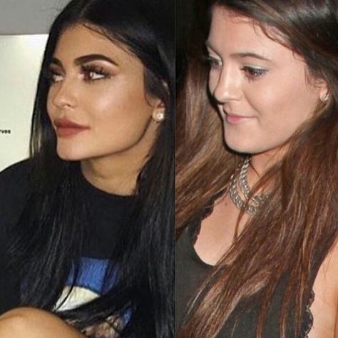 Kylie Jenner Plastic Surgery, Celebrity Surgery, Bad Plastic Surgeries, Aesthetic Surgery, Botox Lips, Natural Makeup For Brown Eyes, Facial Surgery, Facial Fillers, Facial Contouring