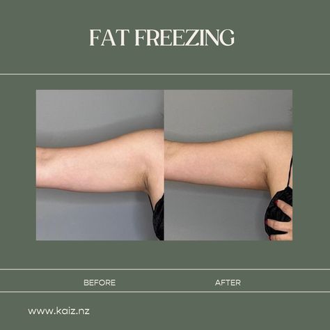 The results speak for themselves! Take a look at this amazing transformation in our client's before-and-after photos, showing a dramatic change in their arms. The visible reduction in fat and the sculpted look are proof that our treatments work.

Imagine seeing a similar transformation in yourself. If you're ready to achieve these kinds of results, there's no better time to start than now. Our expert team is here to guide you through the process, answer your questions, and create a personalized Body Contouring, Change In, To Start, That Look, Take That