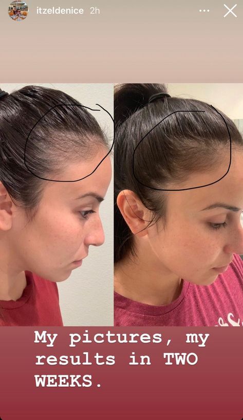 Laser Aesthetic, Monat Haircare, Hairline Tattoos, Hair Fall Solution, Stop Hair Breakage, Healthy Natural Hair Growth, Indian Diet, Korea Girl, Hair Growing Tips