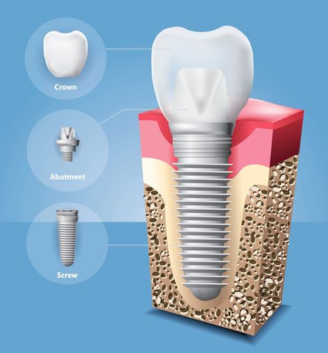 Dental Illustration, Prosthetic Teeth, Free Dental Implants, Dental Advertising, Dentist Teeth, Dental Images, Best Dental Implants, Human Teeth, Dental Design