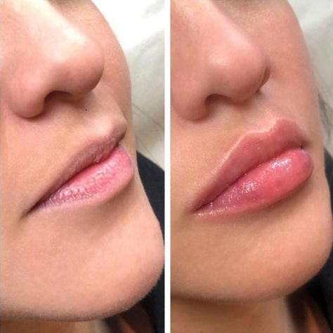 Lip Threading, Lip Ideas, Lip Flip, Lips Inspiration, Botox Lips, Cosmetic Dermatology, Lip Filler, Botox Fillers, Face Makeup Tips