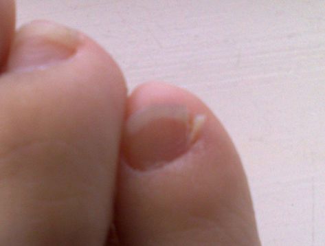 Nail Infection Broken Toenail, Split Toenail, Toenail Problems, Nail Remedies, Split Nails, Nail Problems, Nail Infection, How To Do Splits, Ingrown Nail