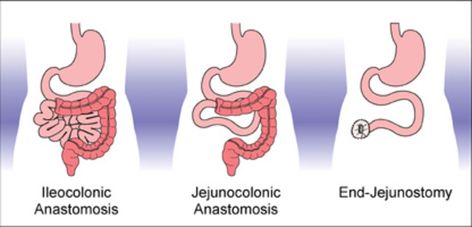 Short bowel syndrome (SBS) is a malabsorption syndrome caused as a result of the small intestine not functioning efficiently. One of the prime symptoms of short bowel syndrome is diarrhea, which leads to dehydration, malnutrition, and unexplained and drastic weight loss in most the patients. Short Bowel Syndrome, Small Intestine, Dehydration, Nerve, Pediatrics, Health Care, Marketing, Health, Quick Saves