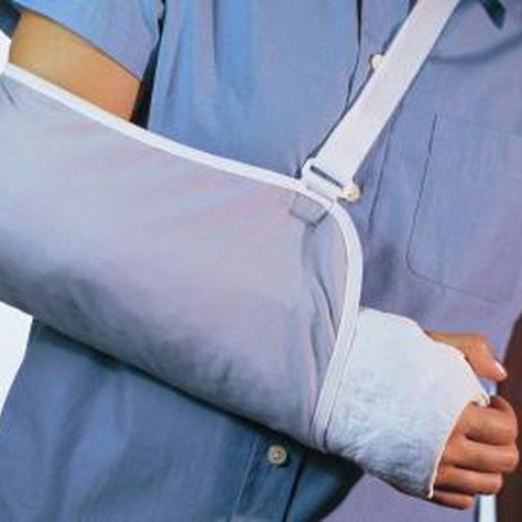 Create a fake arm cast without a visit to the doctor. Broken Arm Cast, Scaphoid Fracture, Arm Cast, Making Paper Mache, Personal Injury Claims, Leg Cast, Personal Injury Law, Broken Arm, Personal Injury Lawyer