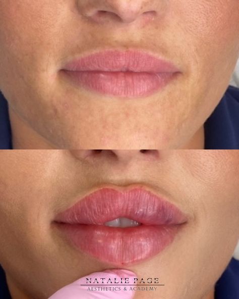 Take a look at this before and after lip filler! How fabulous! These lips are absolute perfection. Our outstanding technique allows us to give clients completely bespoke lips! #russianlip #russianlipslondon #londonrussianlips #russianlips #russianlips #lipfillerslondon #fillersmalm #lipfillersliverpool #lipfillersessex #russianlips #russianlipstechnique #nataliepageaesthetics #nataliepageaestheticsacademy Lip Fillers Juvederm, Facial Fillers, Lip Filler, Eyeliner Tattoo, Lip Injections, Perfect Lips, Lip Fillers, Brow Makeup, Plastic Surgery