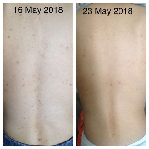 Pimple, acne, blemish on back improve after a week of applying Asea Renu 28 gel Short Messages, Herbal Remedies, Our Body, On Back, How To Introduce Yourself, Tattoo Quotes, Acne, Healing, Repair