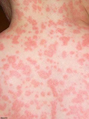 Skin conditions can be hard to diagnose as many cause a similar looking skin bump or blemish. Learn about skin rashes and telltale signs to tell them apart. Common Skin Rashes, Multiple Chemical Sensitivity, Skin Rashes, Heat Rash, Home Remedies For Skin, Skin Bumps, Vitamin Deficiency, Natural Acne Remedies, Dry Skin Remedies