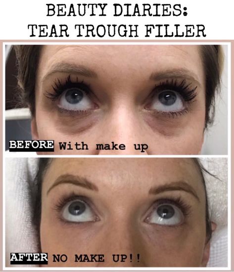 Beauty Diaries: Tear Trough Filler - House of Hargrove Trough Filler Before After, Eye Trough Filler, Tear Through Eye Filler, Tear Trough Makeup, Eye Trough Filler Before And After, Tear Trough Filler Before After, Eye Hollows, Tear Trough Filler, Botox Migraine