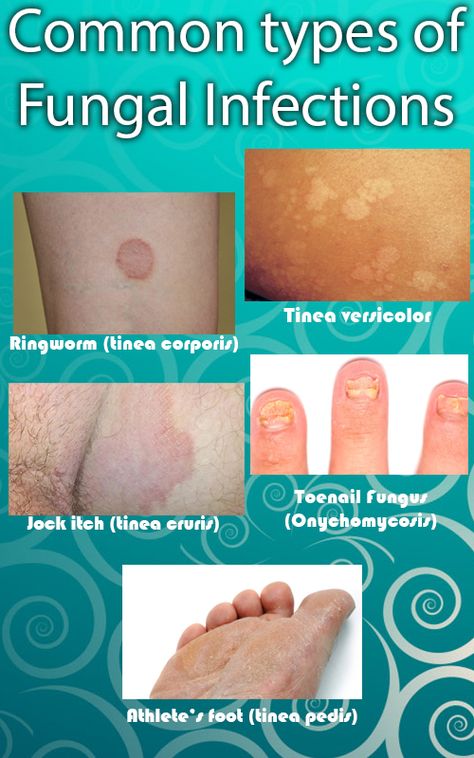 Tinea Corporis, Tinea Versicolor, Toenail Fungal Infection, Fungal Infection Skin, Toenail Fungus Remedies, Natural Antibiotics, Nursing Tips, Toenail Fungus, Fungal Infection