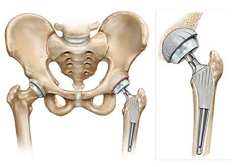 Hip Implants, Ankle Pumps, Hip Problems, Hip Surgery, Knee Replacement, Healthy Exercise, Greater Noida, Biochemistry, Jaipur Rajasthan