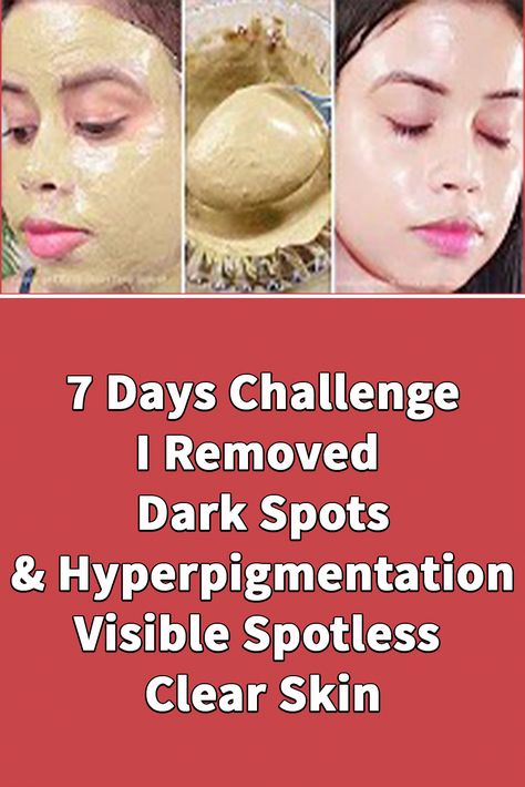 Get Rid Of Pigmentation On Face, Face Tips Skincare, 7 Days Challenge, Fizzy Hair, Turmeric Facial, Hand Health, French Pharmacy, Natural Mask, Face Cleaning