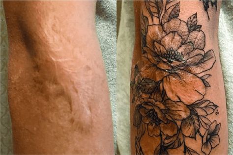 What to Know About Using Tattoos to Cover Scars | Removery Leg Scar Tattoo, Scar Cover Tattoo, Scars Tattoo, Tattoo Scar, Cover Tattoos, Tattoo Over Scar, White Tattoos, Tattoos To Cover Scars, Scar Tattoo