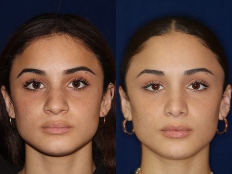 Rhinoplasty Inspiration, Ethnic Nose Job, Ethnic Nose, Jaw Reduction Surgery, Nose Surgery Rhinoplasty, Ethnic Rhinoplasty, Bulbous Nose, Plastic Surgery Fail, Rhinoplasty Nose Jobs