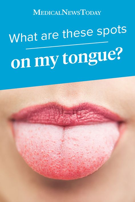 The tongue has lots of small spots on it. Learn about the role they perform, along with the signs of abnormal spots to look out for: https://www.medicalnewstoday.com/articles/322841.php Bumps On Tongue, Constant Headaches, Homemade Facial Mask, Canker Sore, Tongue Health, Health Signs, Learn Yoga, The Tongue, Health Guide