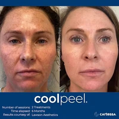 Cool Peel Before & After Photos | Lorena Luca Med + Spa Coolpeel Laser, Medical Website Design, Laser Skin Care, Antiaging Skincare, Laser Resurfacing, Digital Marketing Design, Aesthetic Clinic, Skin Care Clinic, Physician Assistant