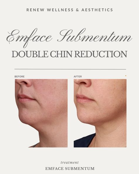 Experience the latest breakthrough in facial rejuvenation! We’re excited to introduce EMFACE Submentum, the newest addition to our lineup. As the first clinic in Oklahoma and among the pioneers nationwide, we’re thrilled to offer this non-invasive solution targeting every layer from muscle to skin, reducing double chin by 31%! EMFACE revolutionizes facial lifting and tightening with its needle-free approach, utilizing radio frequency (RF) and high-intensity electromagnetic stimulation (HIFES... Reducing Double Chin, Double Chin Reduction, Reduce Double Chin, Facial Rejuvenation, Double Chin, Med Spa, Radio Frequency, Oklahoma, Facial