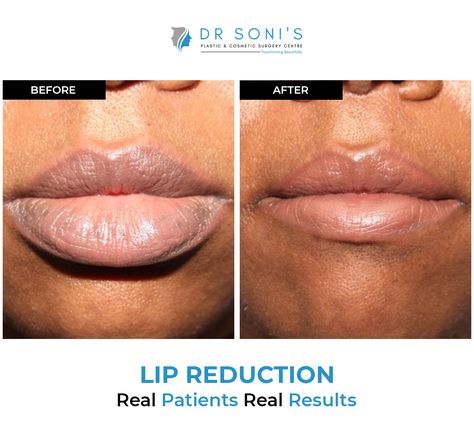 Lip Reduction, Surgical Procedures, Reduction Surgery, Surgery Center, Best Hospitals, Real Results, Cosmetic Surgery, Surgery, Lips