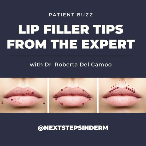 Lip Filler Shapes Chart, Lip Filler Injection Points, Lip Filler Injection Techniques, Lip Filler Mapping, Lip Flip Vs Filler, Versa Lip Filler, Russian Lip Filler Technique, Lip Filler Styles, Lip Fillers Before And After 1ml