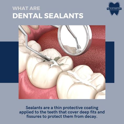 Dental Sealants, Dental Cabinet, Dentist Day, Dental Posts, Dentistry Student, Dental Fun, Dental Facts, How To Prevent Cavities, General Dentistry