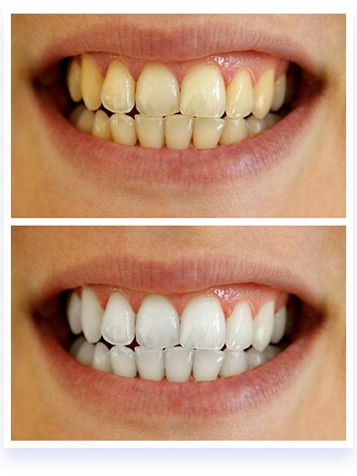 Have White Teeth Red Wine Stains, Teeth Bleaching, Teeth Whitening System, Yellow Teeth, Tooth Enamel, Wine Stains, Red Led Lights, White Smile, Natural Teeth Whitening