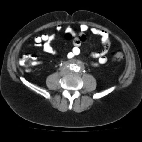 Retroperitoneal fibrosis is a condition previously been described as chronic periaortitis. It is an is an uncommon fibrotic reaction in the retroperitoneum that typically presents with ureteral obstruction. Retroperitoneal fibrosis may lead to ureteric obstruction and consequent renal failure.    Read more: http://radiopaedia.org/articles/retroperitoneal-fibrosis-1 Superior Mesenteric Artery, Renal Cell Carcinoma, Polycystic Kidneys, Vein Thrombosis, Pediatric Care, Ct Scan, Medical Imaging, Abdominal Pain, Radiology