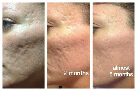 Achne scarring is sooooo painful to keep... let it go! Procell Microchanneling, Laser Resurfacing, Acne Scar Removal, Acne Breakout, Scar Removal, After Pictures, Chemical Peel, Anti Aging Treatments, Before And After Pictures