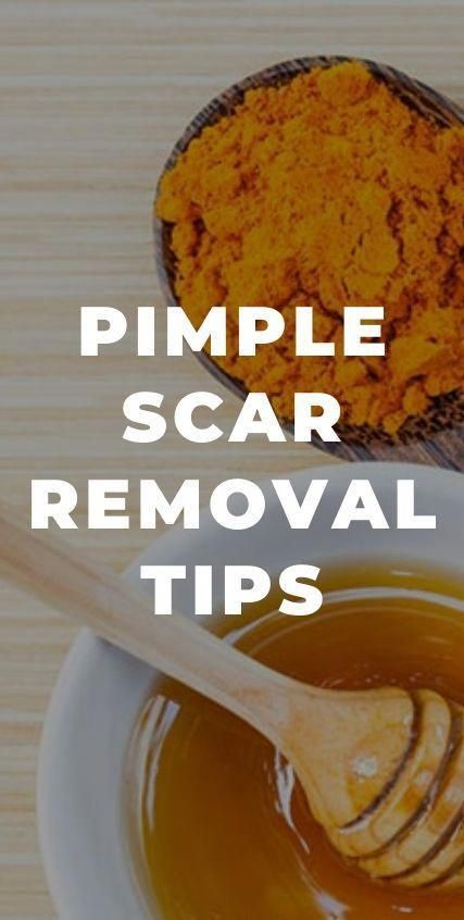 Nobody likes pimples obviously. The best way to keep your skin free of pimple marks is to prevent breakouts. 10 Pimple Scar Removal Tips Pimple Scar Removal, Pimple Solution, Scar Remedies, Cystic Acne Remedies, Home Remedies For Pimples, Blind Pimple, Pimples Under The Skin, Pimples Remedies, Pimple Scars