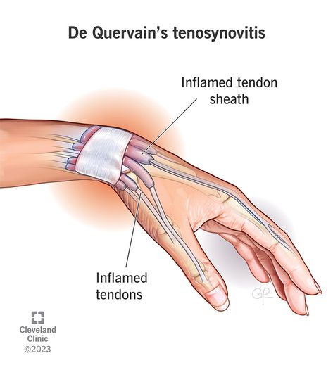 Signs Of Inflammation, Wrist Exercises, Trigger Finger, Cleveland Clinic, Medical Terms, Rare Disease, What If Questions, Human Services, Health Articles