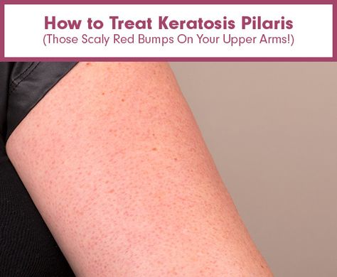 How to Treat Keratosis Pilaris (Those Scaly Red Bumps On Your Upper Arms!) Bumps On Arms, All Things Girly, One And Done, Keratosis Pilaris, Upper Arms, Savannah Georgia, Beauty Recipe, Beauty Routine, Beauty Treatments