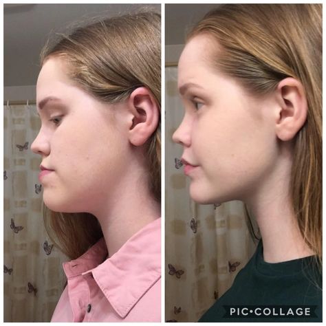 (15) Before vs 6 weeks post op! I had double jaw surgery (not sure the exact movements) but upper jaw was moved forward and lower jaw back. Super happy with the results, honestly mind blowing! : jawsurgery Mewling Jaw, Jaw Surgery Before And After, No Chew Diet After Jaw Surgery, Jaw Surgery Before And After Underbite, Double Jaw Surgery Before And After, Jaw Surgery Recovery Tips, Jaw Surgery Before And After Overbite, Double Jaw Surgery, Kpop Plastic Surgery