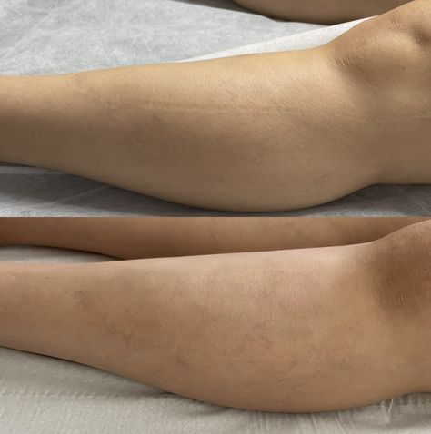 Image of before and after inkless tattooing technique on a childhood leg scar. Results from 1 session are amazing about 70% improvement in the appearance making the scar less visible Scar Revision, 8 Weeks, Camouflage