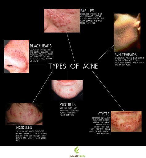 what acne types you’re dealing with if you’re serious about treating it as soon as possible...Here is a list of the main types of acne and... acne is caused Acne Types, Different Types Of Acne, Forehead Acne, Natural Acne Remedies, Types Of Acne, Acne Causes, Acne Remedies, Acne Skin, Skin Care Acne