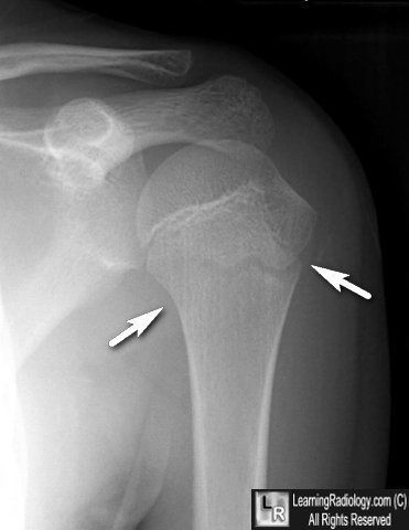 Normal Epiphyseal Plate:  Don't confuse the undulations of the humeral epiphyseal plate for a fracture Epiphyseal Plate, Radiology Imaging, Xray Technician, Medical Imaging, Moon Signs, Best Website, Radiology, X Ray, Half Moon