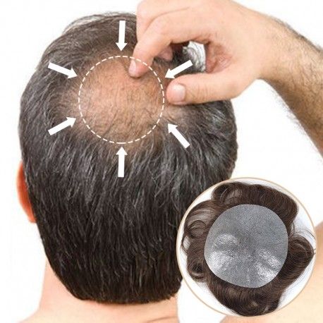 Best Hair Patches Online Hair Replacement Systems, Male Pattern Baldness, Pattern Baldness, Human Hair Clip Ins, Crown Hair, Bald Hair, Hair System, Hair Solutions, 100 Remy Human Hair