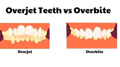 Overjet Teeth Vs Overbite: What’s Different? Overbite Teeth, Make Life Easier, Life Hack, Dental Clinic, The 1950s, Care Routine, Perth, Skin Care Routine, Orchids