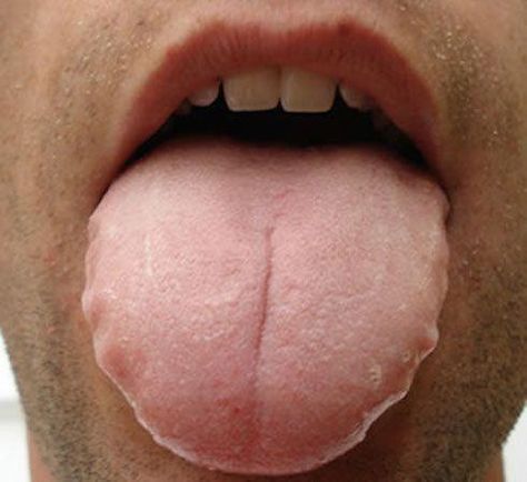 Bumps On Tongue, Scalloped Tongue, Tongue Sores, Ayurvedic Diet, Swollen Tongue, Tongue Health, Teeth Health, Nail Care Tips, Natural Teeth Whitening