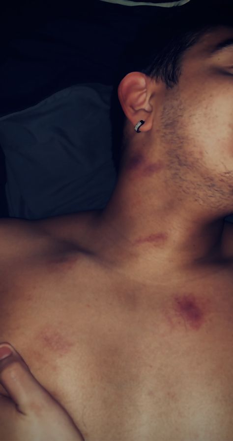 Lovebites Images Couples, Love Bites Hickey For Boys, Love Bites Mark Aesthetic, Neck Bite Boyfriend, Love Bite Snap, Love Bite Boyfriend, Love Bite Photos, Boyfriend Snap, Private Boyfriend