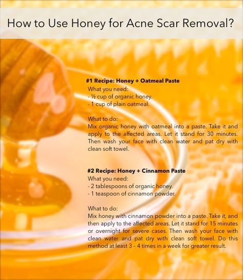 Acne Cream Diy, Face Acne Scar Removal, Diy Acne Scar Remover, Acne Chart, Get Rid Of Acne Scar, Natural Acne Scar Remedy, Best Home Remedy For Acne Scar, Best Acne Scar Removal, Cat Acne