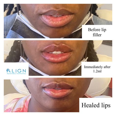 ✨Trust the Process✨ Lip Filler, Lip Fillers, Trust The Process, Healing Process, The Process, Lips, Healing