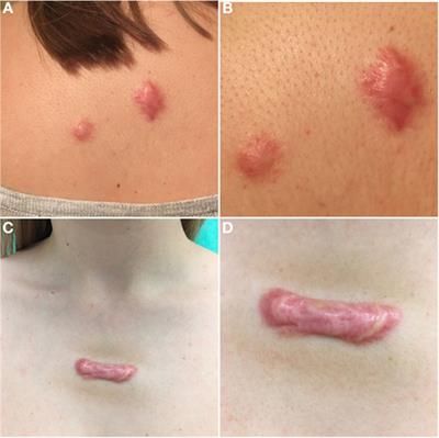 Current Therapeutic Approach to Hypertrophic Scars | Frontiers in Medicine Scar Remedies, Hypertrophic Scars, The Mechanisms, Scarring, Stage Makeup, Oral Health Care, Oral Health, Paw Print Tattoo, Medicine