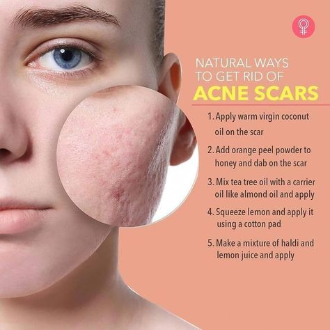 Acne Scar Remedies, Crochet Face Mask, Clear Healthy Skin, Natural Skin Care Remedies, Get Rid Of Acne, Natural Face Skin Care, Rid Of Acne, Good Skin Tips, Skin Care Face Mask