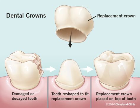 Dental Crowns: What Are They, Types, Procedure & Care Cracked Tooth, Tooth Crown, Dental Decay, Dental Impressions, Dental Fillings, Dental Cavities, Teeth Straightening, Dental Bridge, Dental Veneers