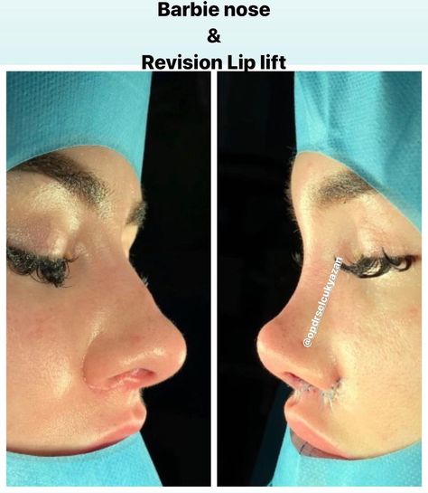 Barbie Nose Rhinoplasty, Barbie Nose, Nose Rhinoplasty, Nose Job, Plastic Surgeon, Nostril Hoop Ring, Nose Ring, Lips, Makeup