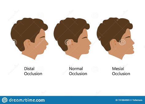 Guy With Distal, Normal, And Mesial Bite Profile, Vector Illustration. Overbite Or Underbite Before And After Stock Vector - Illustration of mouth, malocclusion: 191884969 Braces, Stock Vector, Vector Illustration, Art