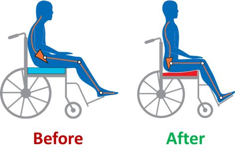 Pressure Ulcer, The Patient, A Chair, Chair Design, Stationary Bike, The One